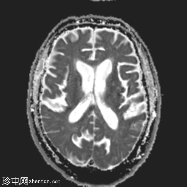 FTD-MND - 行为变异额颞叶痴呆