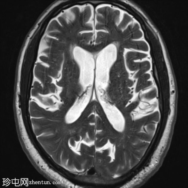 FTD-MND - 行为变异额颞叶痴呆