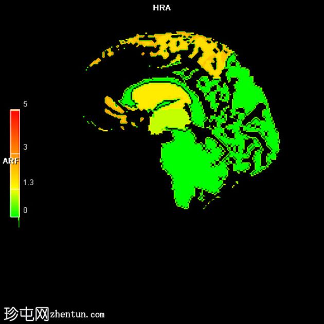 FTD-MND - 行为变异额颞叶痴呆