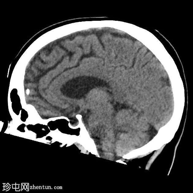 额颞叶痴呆 - 行为变异