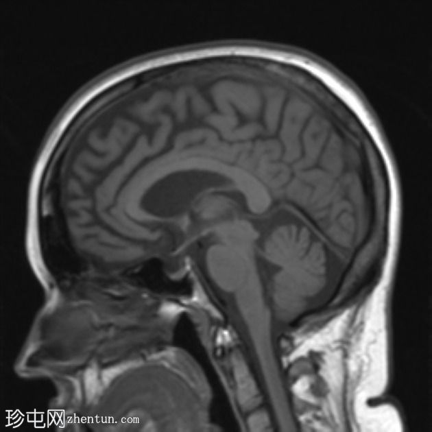 额颞叶痴呆 - 行为变异