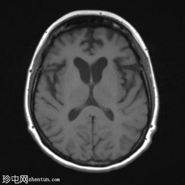 额颞叶痴呆 - 行为变异