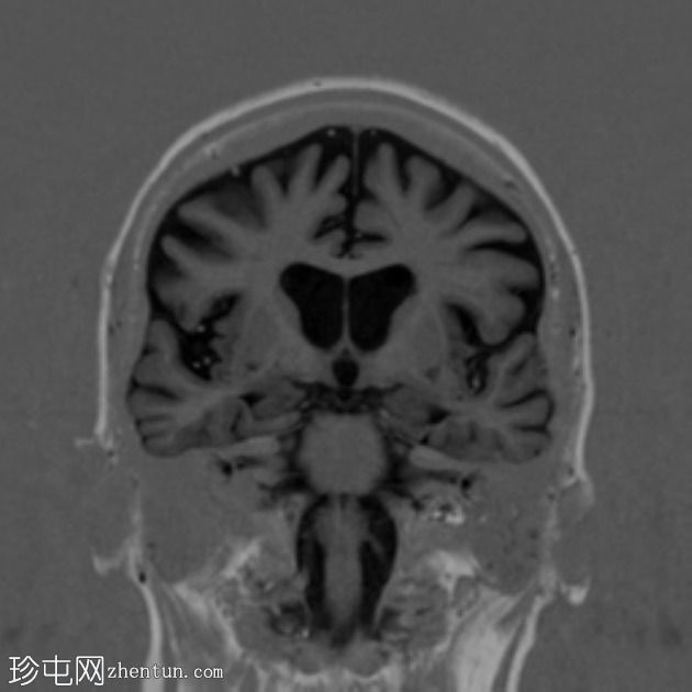 额颞叶痴呆 - 行为变异