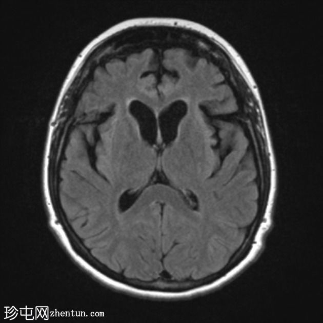 额颞叶痴呆 - 行为变异