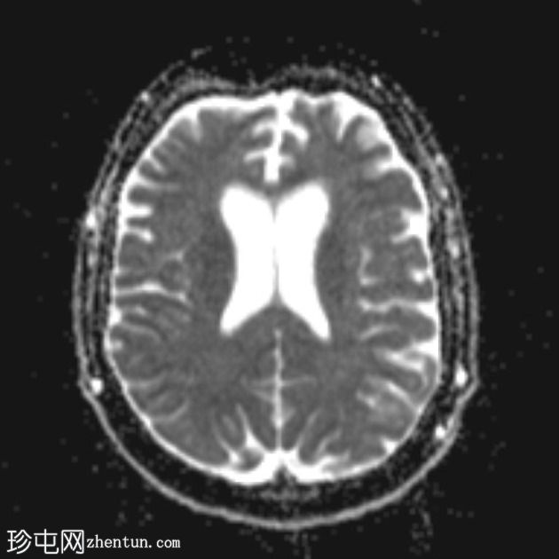 额颞叶痴呆 - 行为变异