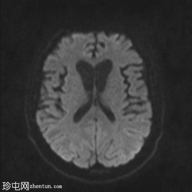 额颞叶痴呆 - 行为变异