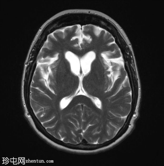 额颞叶痴呆 - 行为变异