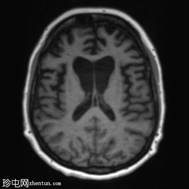 额颞叶痴呆 - 行为变异
