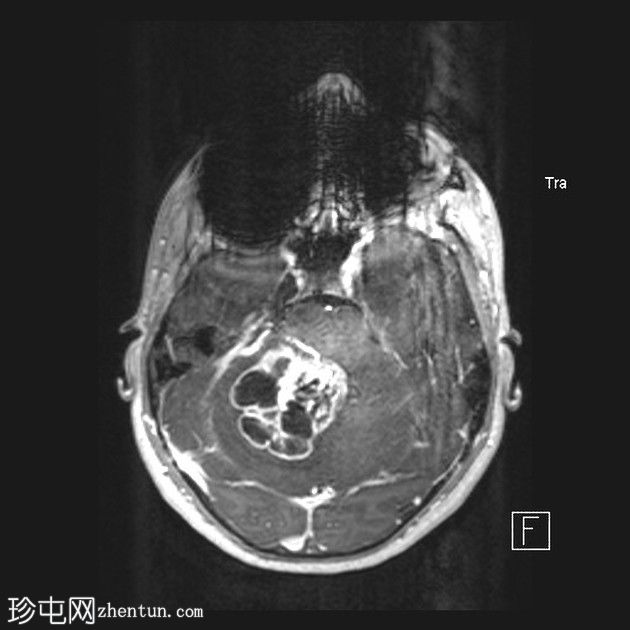 毛细胞性星形细胞瘤（pilocytic astrocytoma）