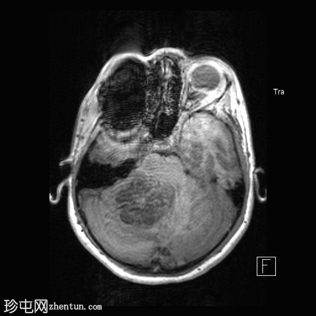 毛细胞性星形细胞瘤（pilocytic astrocytoma）