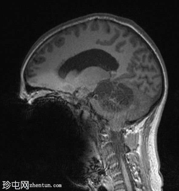 毛细胞性星形细胞瘤（pilocytic astrocytoma）