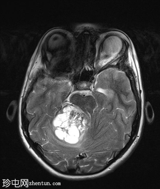 毛细胞性星形细胞瘤（pilocytic astrocytoma）