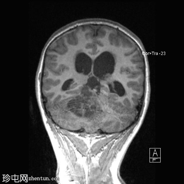 毛细胞性星形细胞瘤（pilocytic astrocytoma）