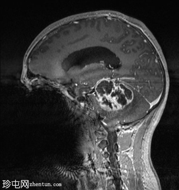 毛细胞性星形细胞瘤（pilocytic astrocytoma）