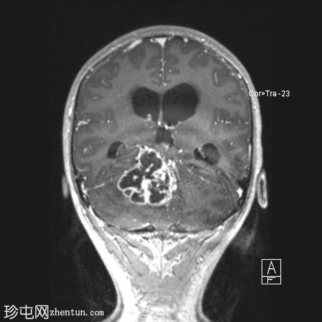 毛细胞性星形细胞瘤（pilocytic astrocytoma）