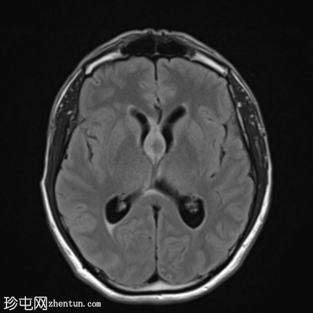 移植后淋巴组织增生性疾病 (PTLD)