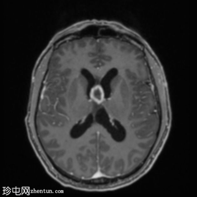 移植后淋巴组织增生性疾病 (PTLD)