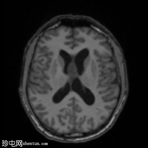 移植后淋巴组织增生性疾病 (PTLD)