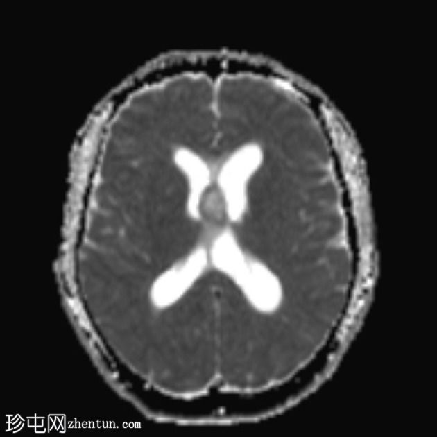 移植后淋巴组织增生性疾病 (PTLD)