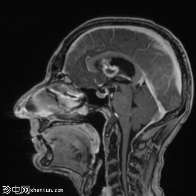 移植后淋巴组织增生性疾病 (PTLD)