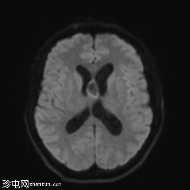 移植后淋巴组织增生性疾病 (PTLD)