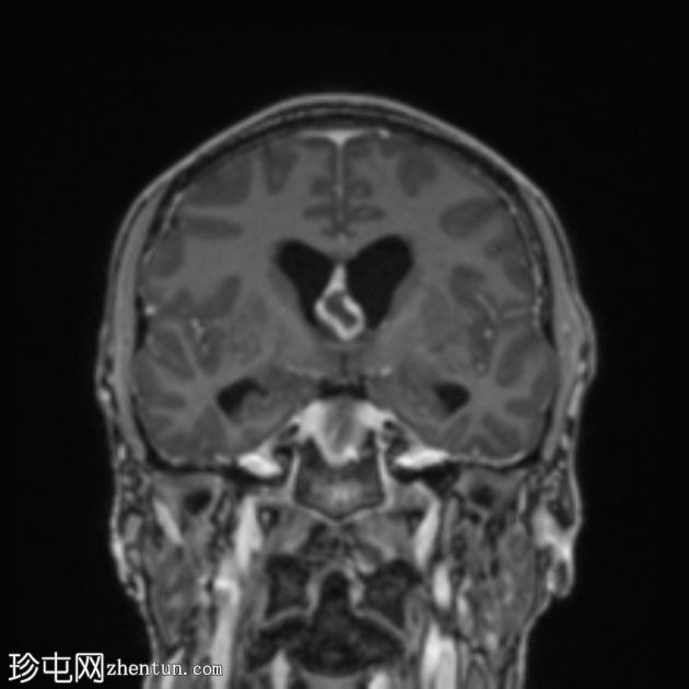 移植后淋巴组织增生性疾病 (PTLD)