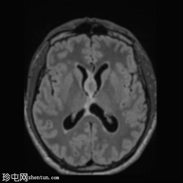 移植后淋巴组织增生性疾病 (PTLD)