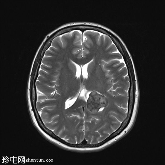 脑室内脑膜瘤
