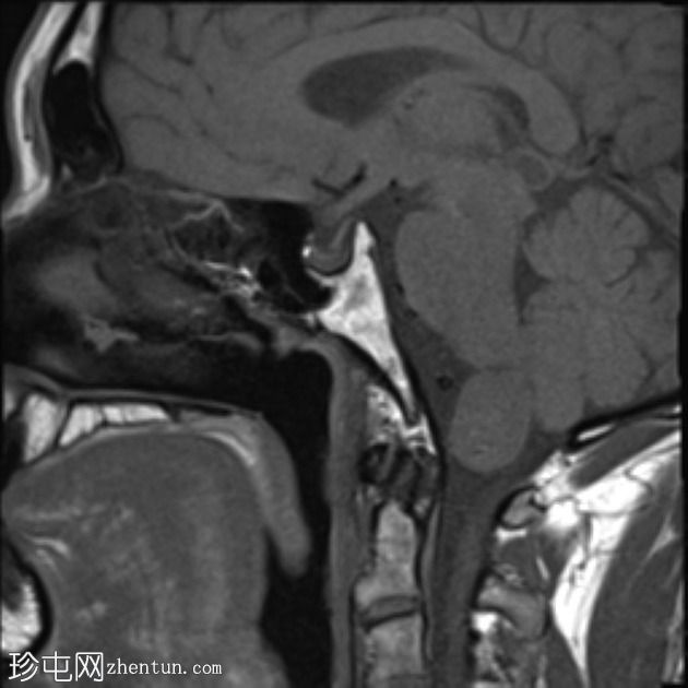 神经鞘瘤 - 枕骨大孔