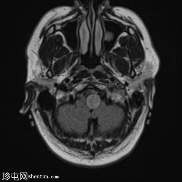 神经鞘瘤 - 枕骨大孔