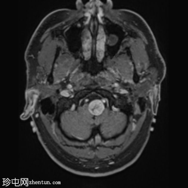 神经鞘瘤 - 枕骨大孔