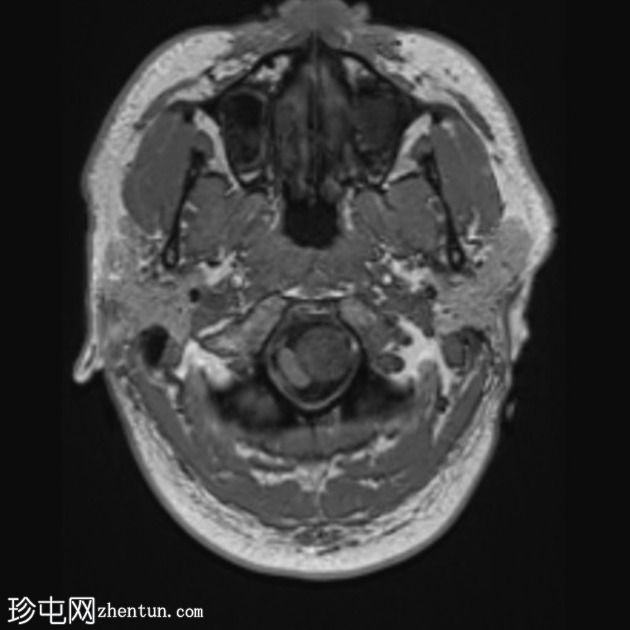 神经鞘瘤 - 枕骨大孔