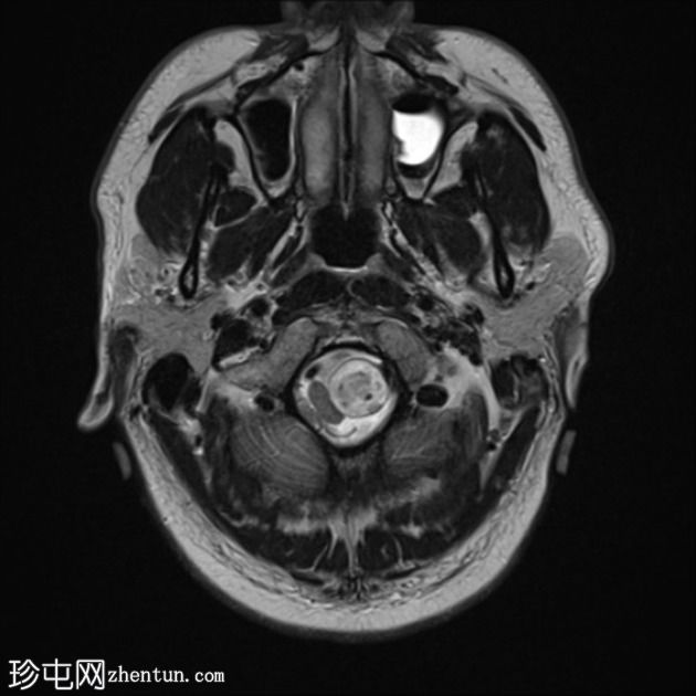 神经鞘瘤 - 枕骨大孔