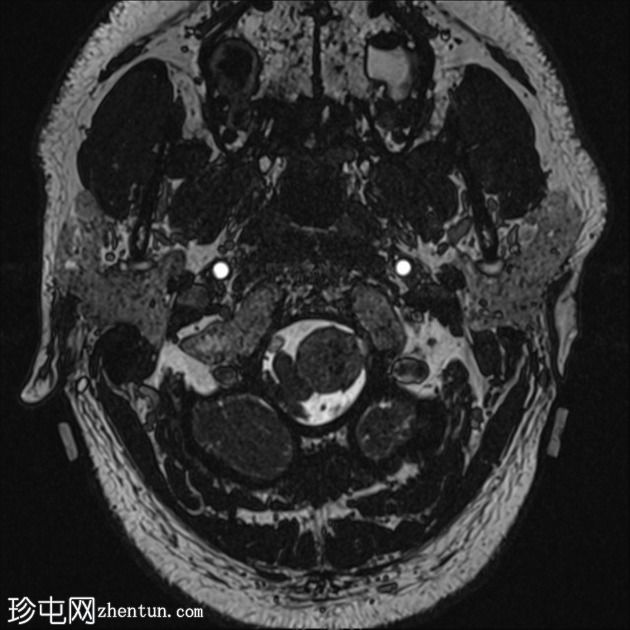 神经鞘瘤 - 枕骨大孔