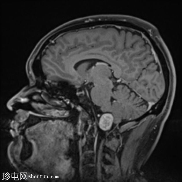 神经鞘瘤 - 枕骨大孔