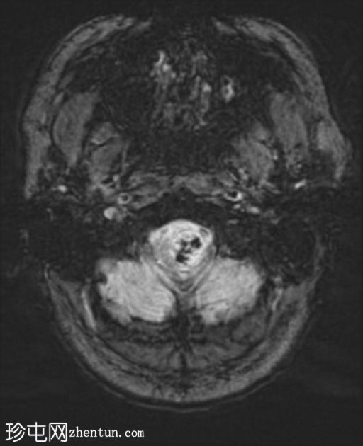 神经鞘瘤 - 枕骨大孔