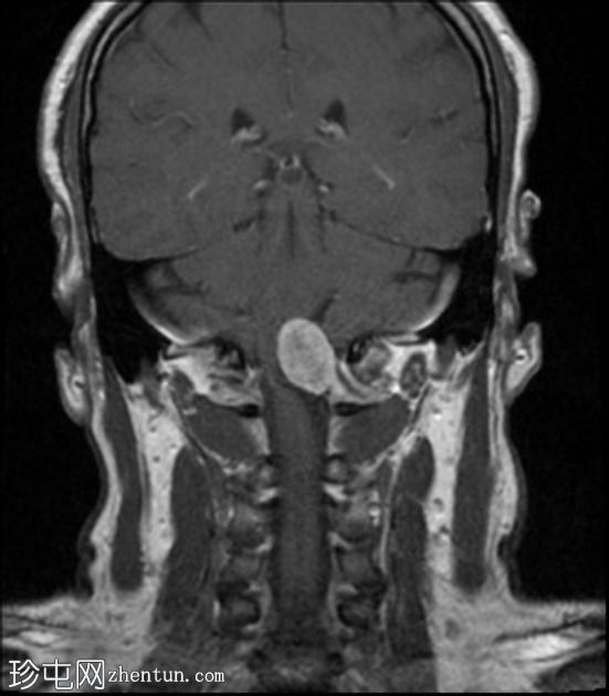 神经鞘瘤 - 枕骨大孔