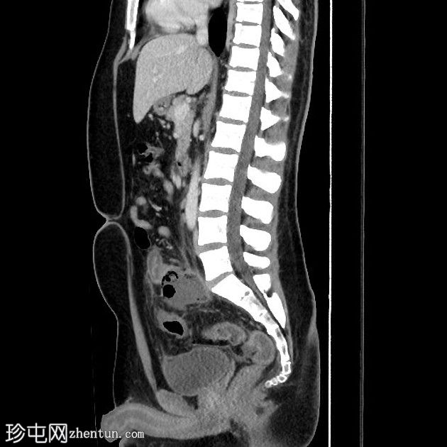 阑尾炎穿孔并有大脓肿