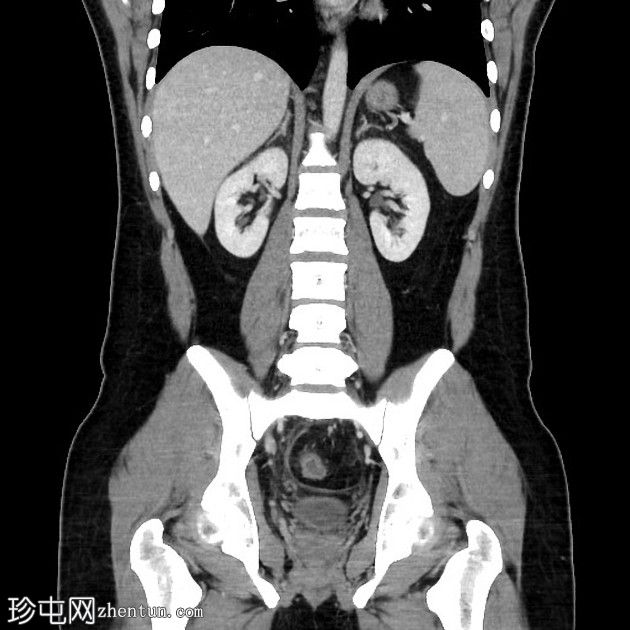 阑尾炎穿孔并有大脓肿