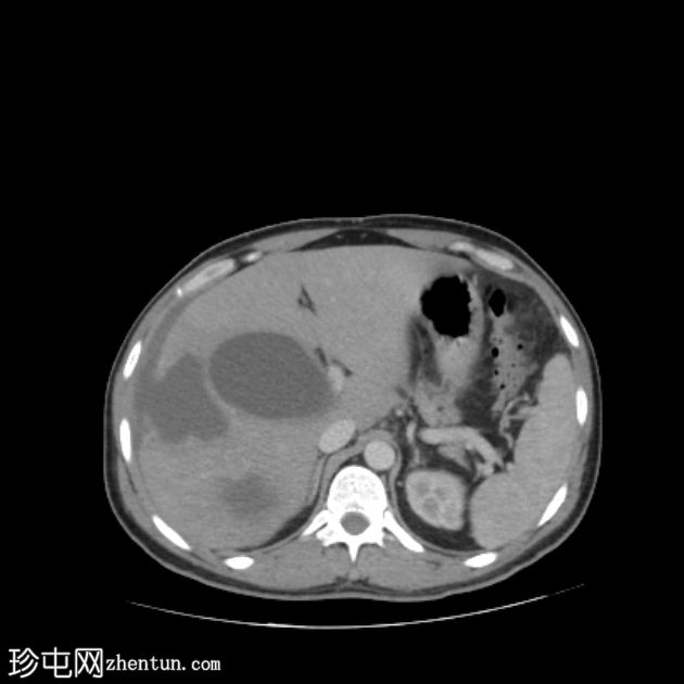 肝包虫囊肿自发性腹腔破裂