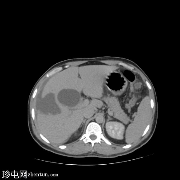 肝包虫囊肿自发性腹腔破裂