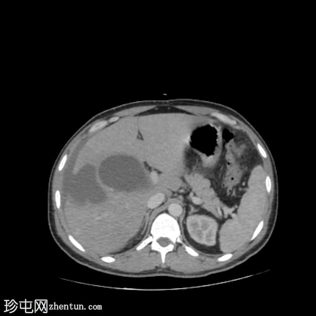 肝包虫囊肿自发性腹腔破裂