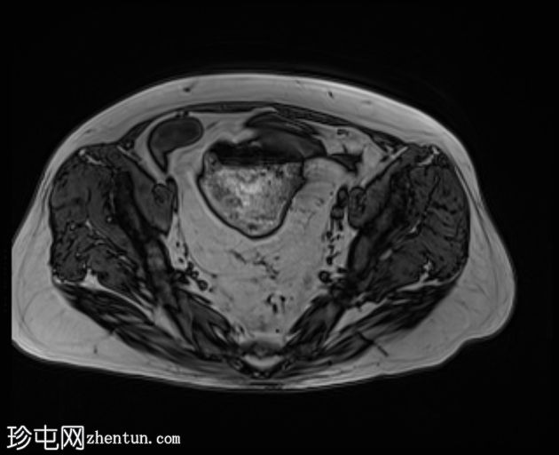 先天性袋状结肠(congenital pouch colon)