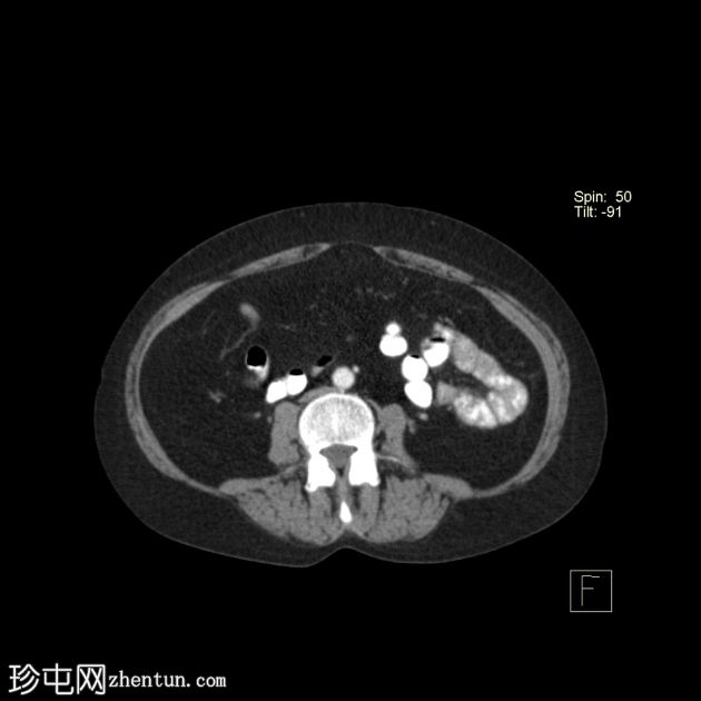 先天性袋状结肠(congenital pouch colon)