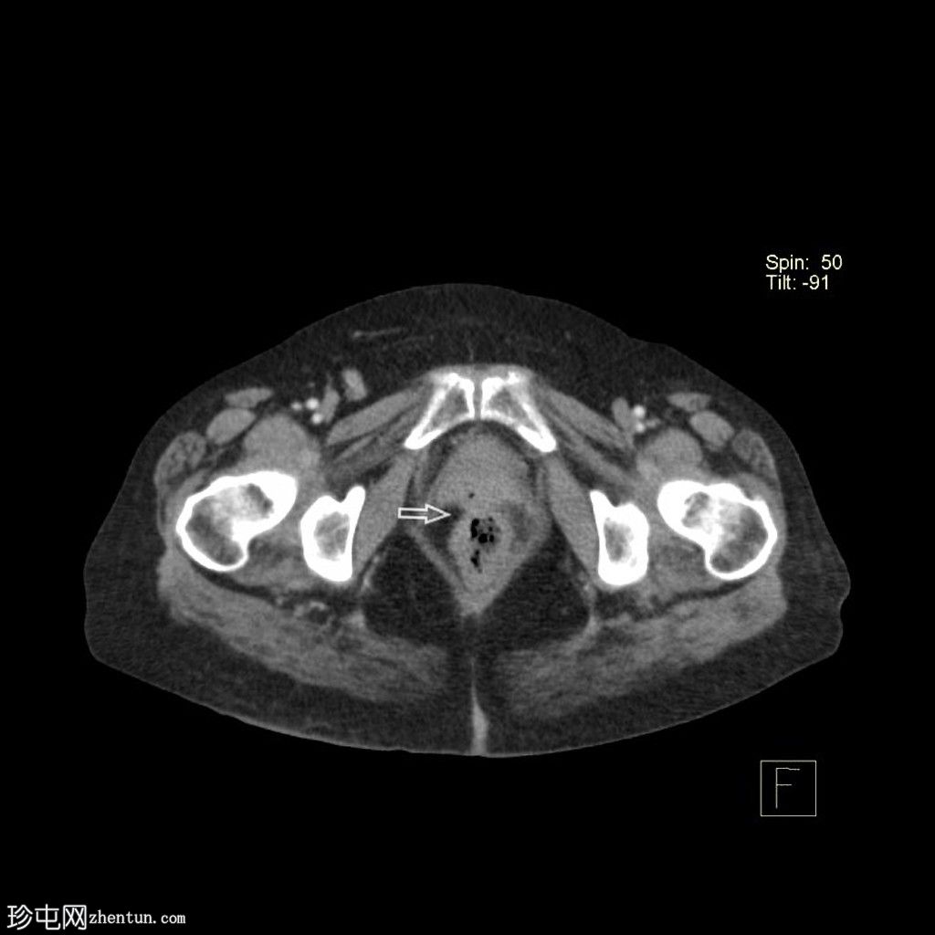 先天性袋状结肠(congenital pouch colon)