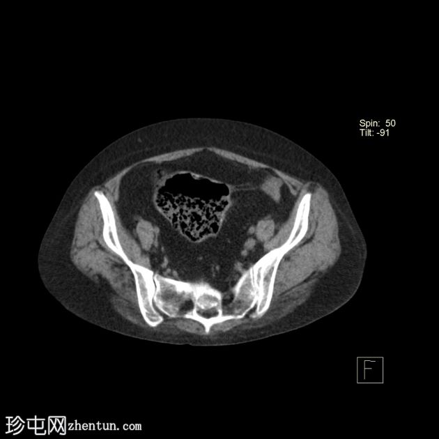 先天性袋状结肠(congenital pouch colon)