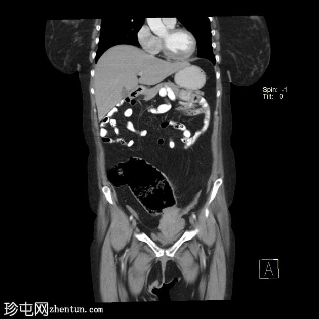 先天性袋状结肠(congenital pouch colon)