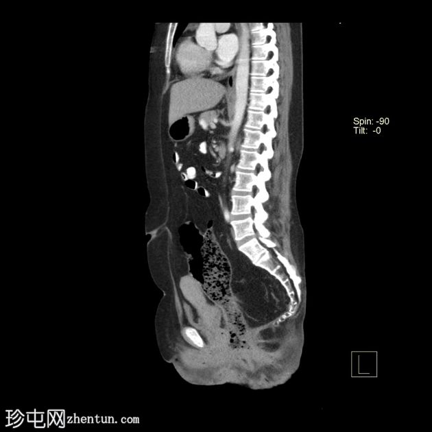 先天性袋状结肠(congenital pouch colon)