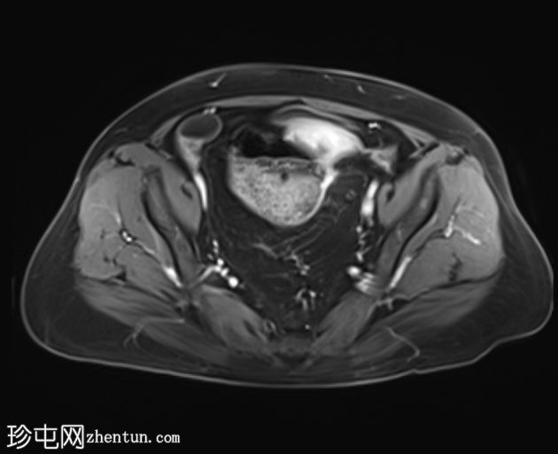 先天性袋状结肠(congenital pouch colon)