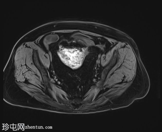 先天性袋状结肠(congenital pouch colon)